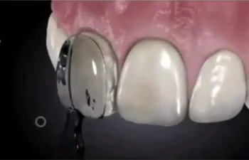 Zobni Sestavljena Iz Porcelana Furnir & Smole Svetlobe Zdravilo Sprednji Zob Model, Hitro, Hitro